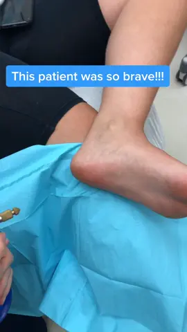 She was so brave!!! warts dermatology skin medical....